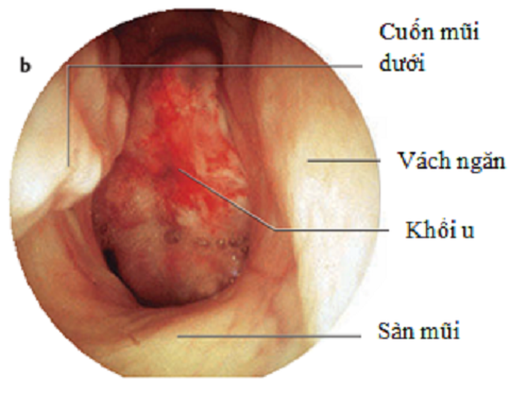 10 dau hieu canh bao ban bi ung thu vom hong-Hinh-9